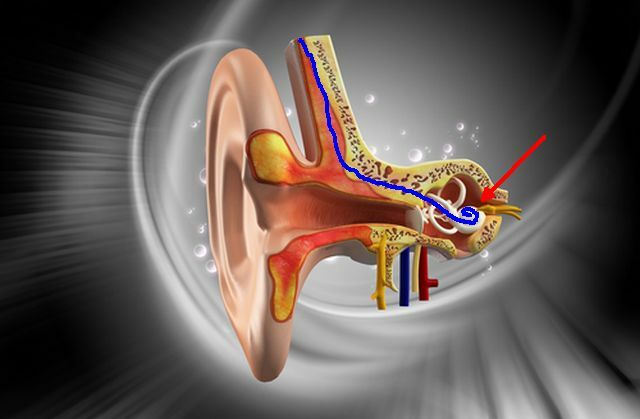 kochlearinis-implantas2